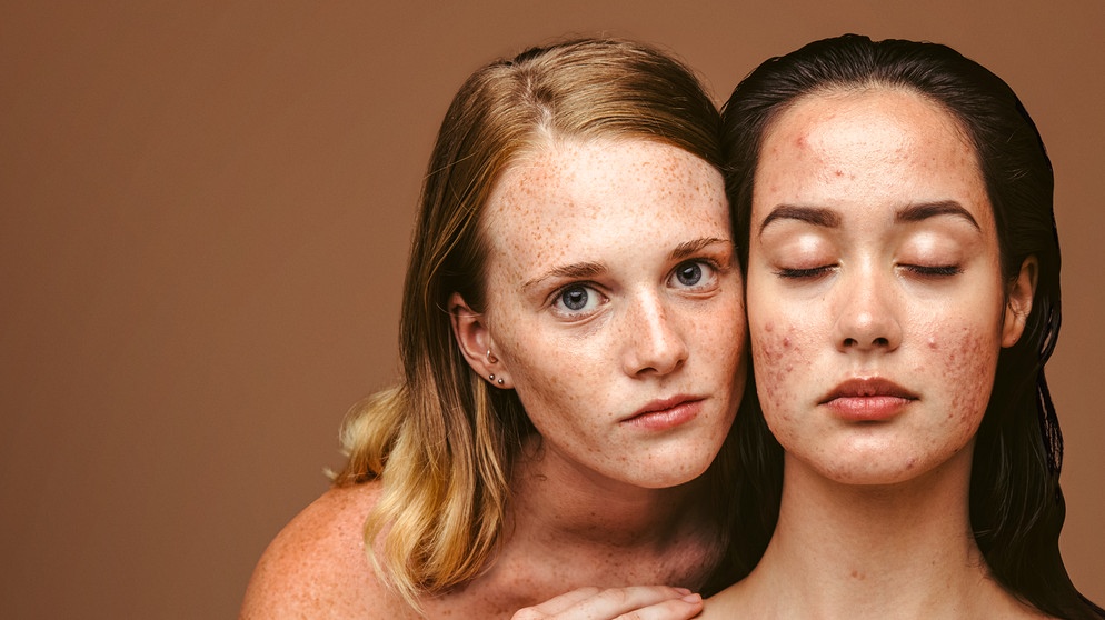 Zwei junge Frauen, Gesicht an Gesicht. Junge Frau links mit geöffneten Augen und makelloser Haut. Rechts junge Frau mit geschlossenen Augen und Akne.  | Bildquelle: stock.adobe.com/Jacob Lund;  Montage: BR
