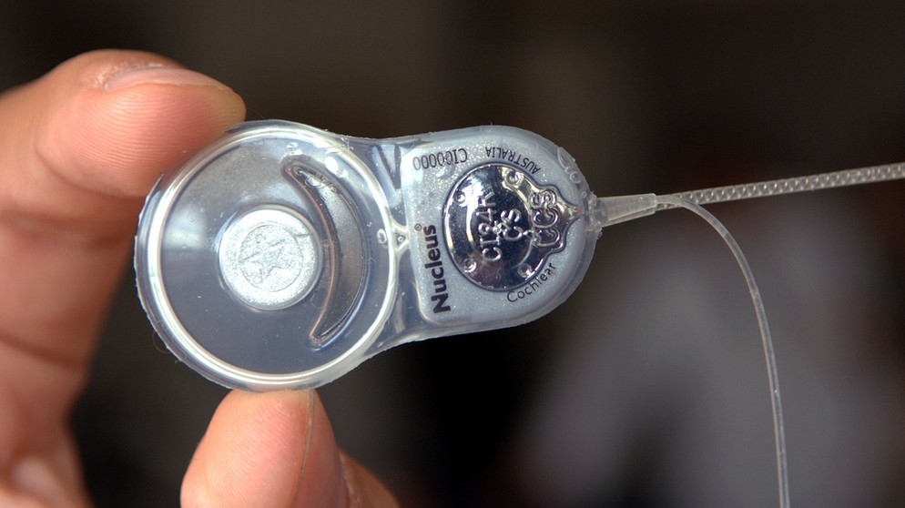 Cochlea Implantat | Bildquelle: picture-alliance/ dpa/dpaweb